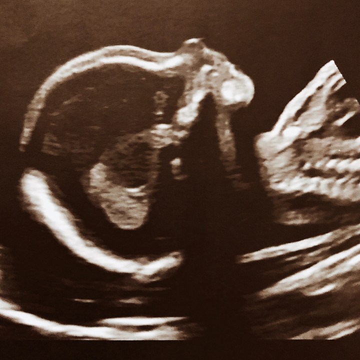 Twenty week scan of a baby's side profile.